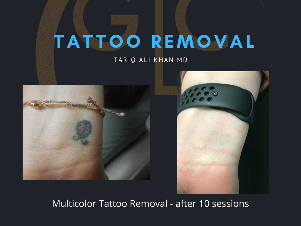 Gentle Care Laser Tustin & Long Beach Before and After picture - Tattoo Removal Mucosal Surface